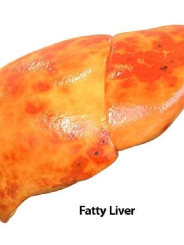 LIVER FATTY