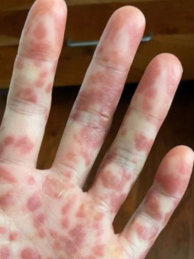 monkeypox se bachne ke upay