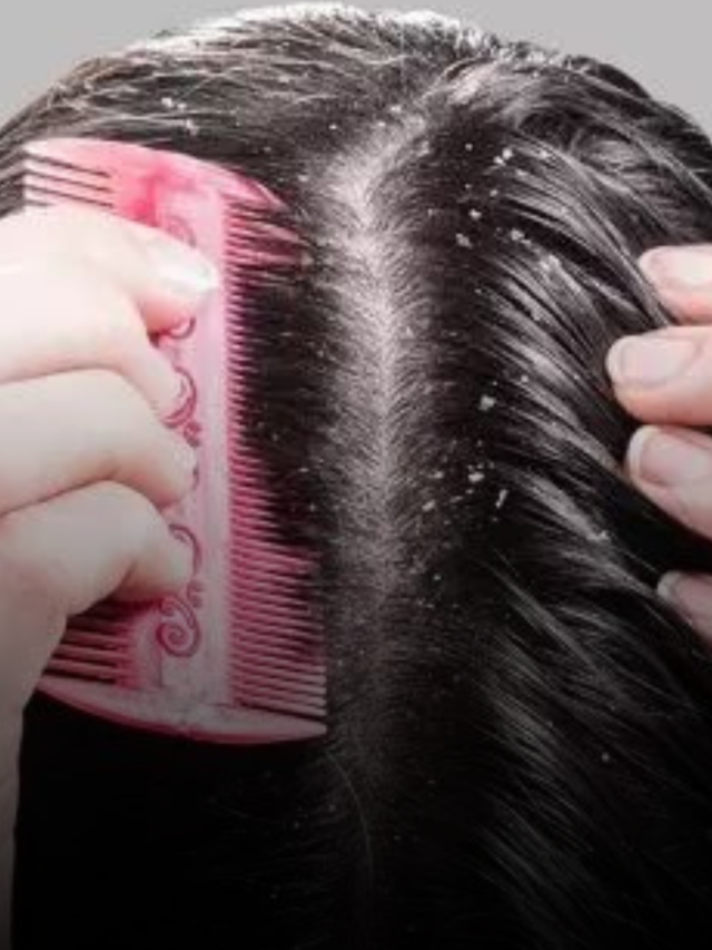 dandruff se chutkara